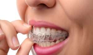 Orthodontics Dental Care Clear Aligners (Invisible Braces)